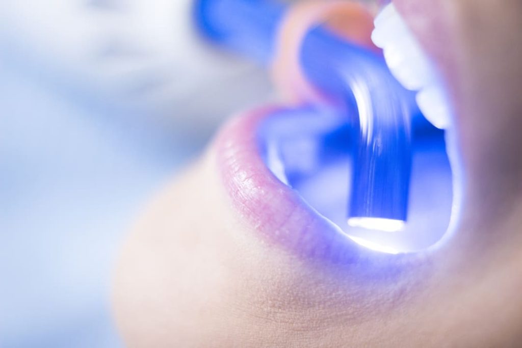 Come ricostruire i denti rotti