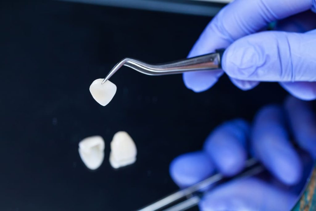 come si mettono le faccette dentali